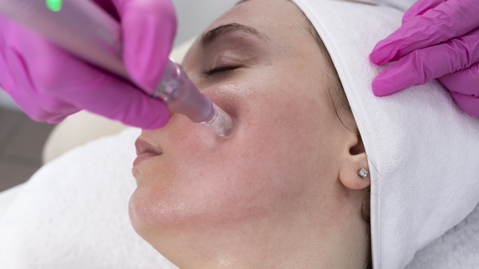 Tratamento de microagulhamento facial numa clínica