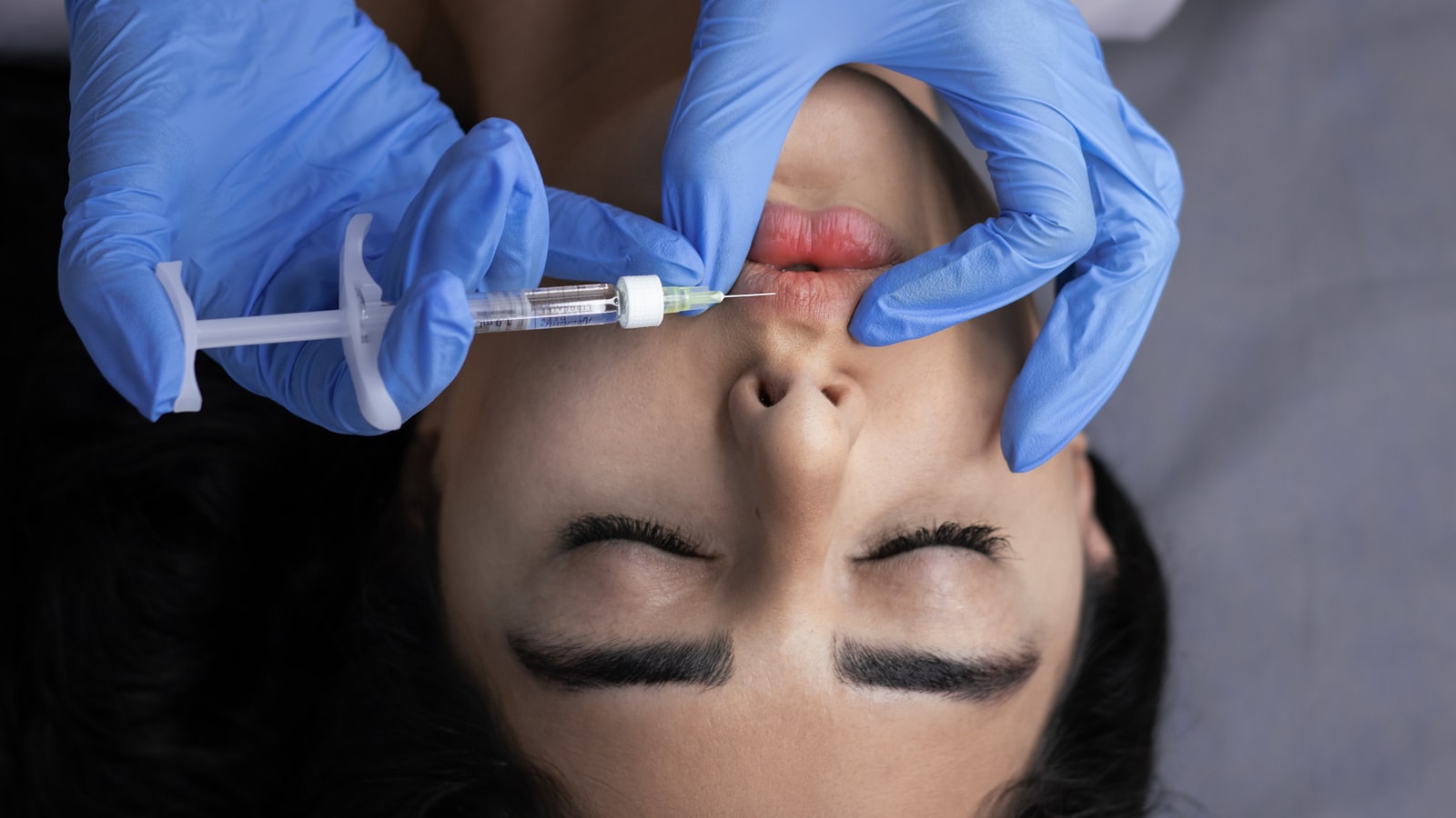 Aplicação de preenchimento com ácido hialurónico nos lábios